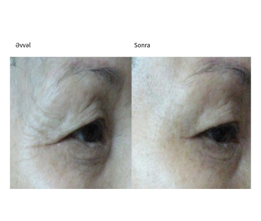 Classys Ultraformer III